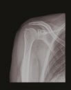 X-ray of a shoulder old style
