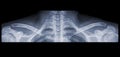 X-ray of a shoulder panorama