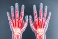 X-ray showing arthritis affecting both human hands, causing inflammation and pain Royalty Free Stock Photo
