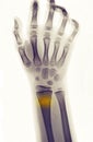 X-ray showing fracture of the distal radius