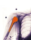 X-ray showing a shoulder replacemen Royalty Free Stock Photo