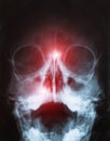 X-ray of sinusitis in a child. Inflammation of the nasal sinuses with purulent sinusitis, close-up