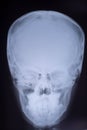 X-ray of the skull bones in direct projection