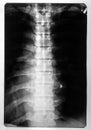 X-ray of the spinal card