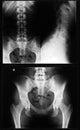 X-ray of the spinal column