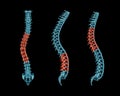 X-ray spinal column with scoliosis, lordosis and kyphosis postures. Pathological vertebrae highlighted in red. Human curvature of