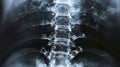 X-ray of spinal trauma with vertebral fractures and spinal cord injury