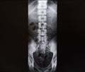 X-ray of the spine and pelvis Royalty Free Stock Photo