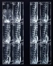 X-ray spine radiography