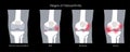 Arthritis in knee joint Royalty Free Stock Photo