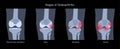 Arthritis in knee joint Royalty Free Stock Photo