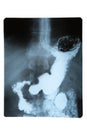 X-ray of stomach