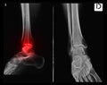 X-ray tarsal, ankle and foot with red painful area Royalty Free Stock Photo