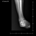 X-ray tarsal and ankle front.