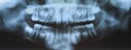 X-ray of teeth