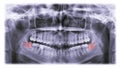 X-ray of teeth, molar tooth improperly growing Royalty Free Stock Photo