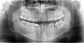 X-ray teeth