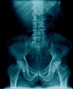 Compression fracture of l-spine Royalty Free Stock Photo