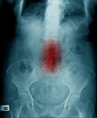 X-ray thoraco-lumbar human structure with pelvic bone Royalty Free Stock Photo