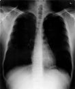 X-ray thorax