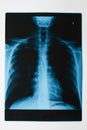 X-ray of a thorax, close-up. X-Ray film of human skeletal system