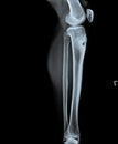 X ray of tibia with infected wound in tibia bone
