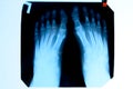 X-ray of toes. Foot on Xray. bone research