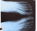 X-ray of toes. Foot on Xray. bone