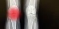 X-Ray of one inflamed knee joint and one healthy knee joint, in black, white and red