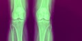 X-Ray of two healthy knee bones in green and purple