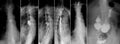 X-ray of the upper gastrointestinal series UGI with barium. Cancer of the esophagus.