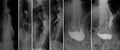 X-ray of the upper gastrointestinal series UGI with barium. Polypoid cancer of the middle third of the esophagus.