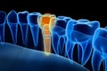 X-ray view of denture with implant. Xray view. Medically accurate illustration