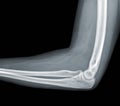 X-ray view of elbow