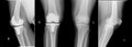X-ray view knees. Right - Total knee replacement show metallic joint implant in bone and left knee - Osteoarthritis.