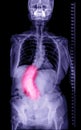 x-ray Whole Spine for diagnosis scoliosis red area.