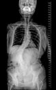 X-ray of Whole Spine for diagnosis scoliosis with scale left side.
