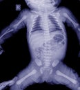 X-ray Whole Thoracic Lumbar Spine lateral baby.and processed blue tone.