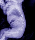 X-ray Whole Thoracic Lumbar Spine lateral baby.and processed blue tone.