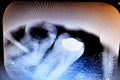 X ray on wisdom 8th lower right tooth with a teeth decay, after exposed nerve and severe pain, swelling and inflammation, Wisdom Royalty Free Stock Photo