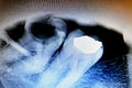 X ray on wisdom 8th lower right tooth with a teeth decay, after exposed nerve and severe pain, swelling and inflammation, Wisdom Royalty Free Stock Photo