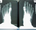 X-ray Of Woman's Foot