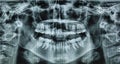 X ray of a womans mouth in 360 rotation