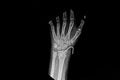 X-ray wrist AP that show fracture distal radius.
