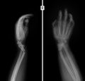 X-ray of the wrist. Greenstick fracture of the radius. Royalty Free Stock Photo