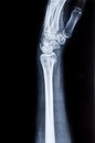 X-ray of the wrist and human radius
