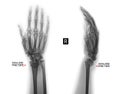 X-ray of the wrist joint. Fracture of the radius. Negative. Marker. Royalty Free Stock Photo