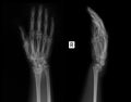 X-ray of the wrist joint. Fracture of the radius.