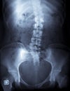 X-ray of a young female spine Royalty Free Stock Photo