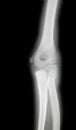 X-ray of a young mans arm Royalty Free Stock Photo